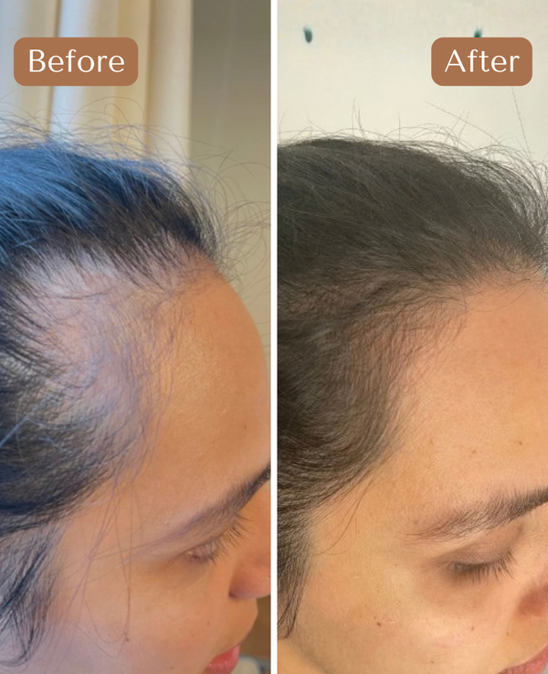 Custom Hair Growth Treatment