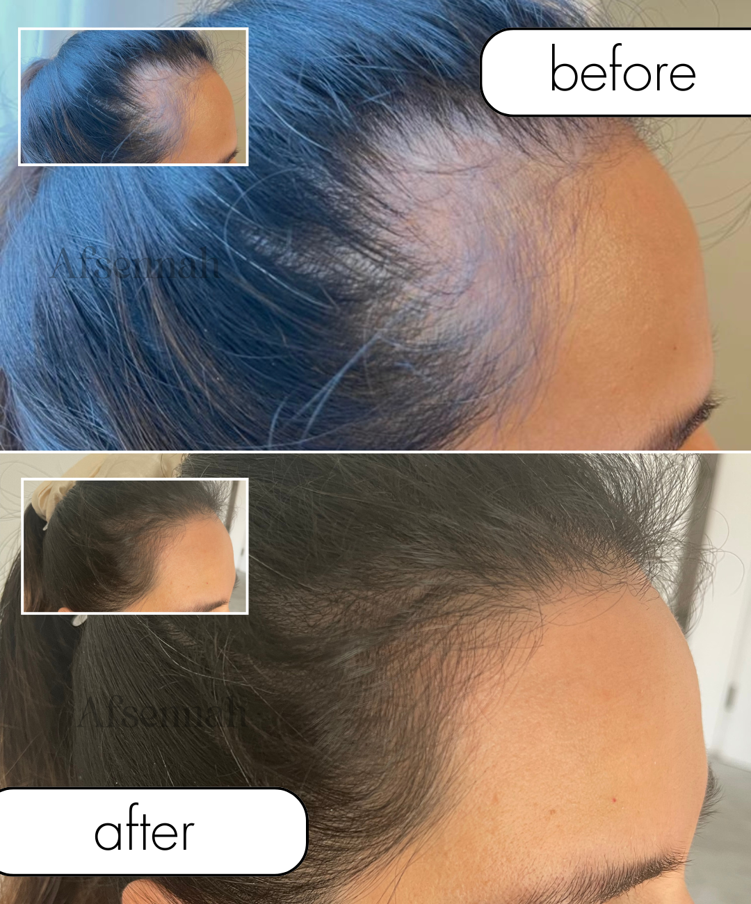 Scalp Treatment