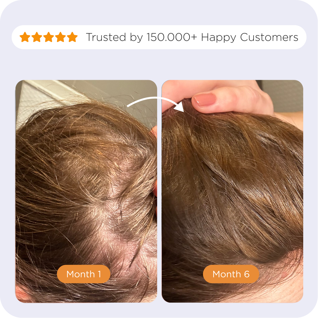 Microneedle Scalp Roller