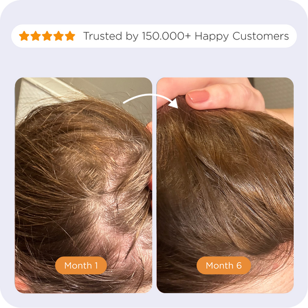 Comparison of the Afsennah Microneedle Scalp Roller against a generic scalp roller
