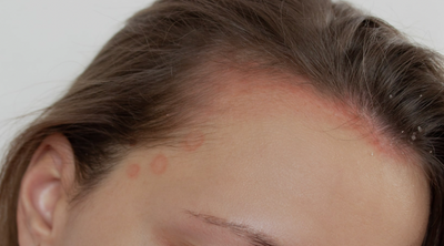 Seborrheic dermatitis