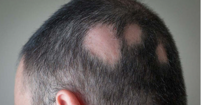 Lichen Planopilaris (important note, scarred areas can not be  resversed)