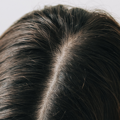 High (Scalp is barely visible)