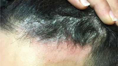 Psoriasis/ Scalp Eczema